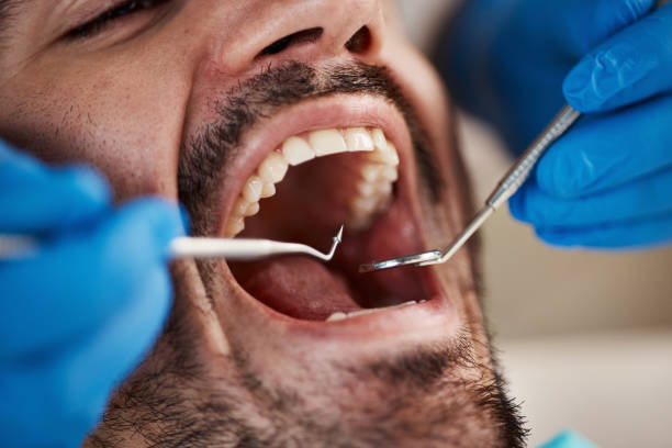 Best Emergency Dental Care for Broken or Chipped Teeth in South Pasadena, CA