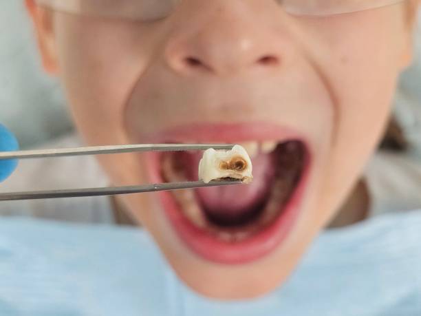 Best Emergency Gum Treatment in South Pasadena, CA